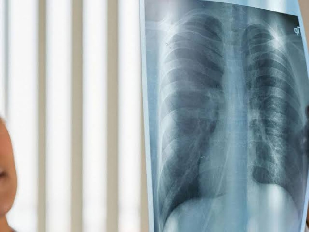 SUS terá três novos medicamentos para câncer de pulmão 