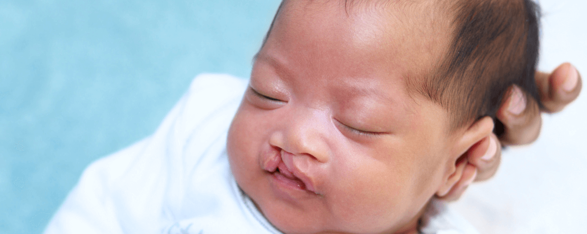 Fissura labiopalatina: quando a fonoaudiologia dá voz à esperança